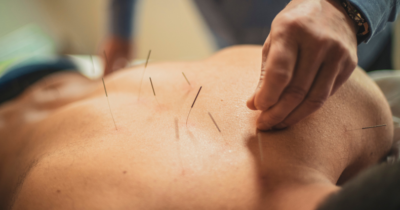 Thinking About Acupuncture?